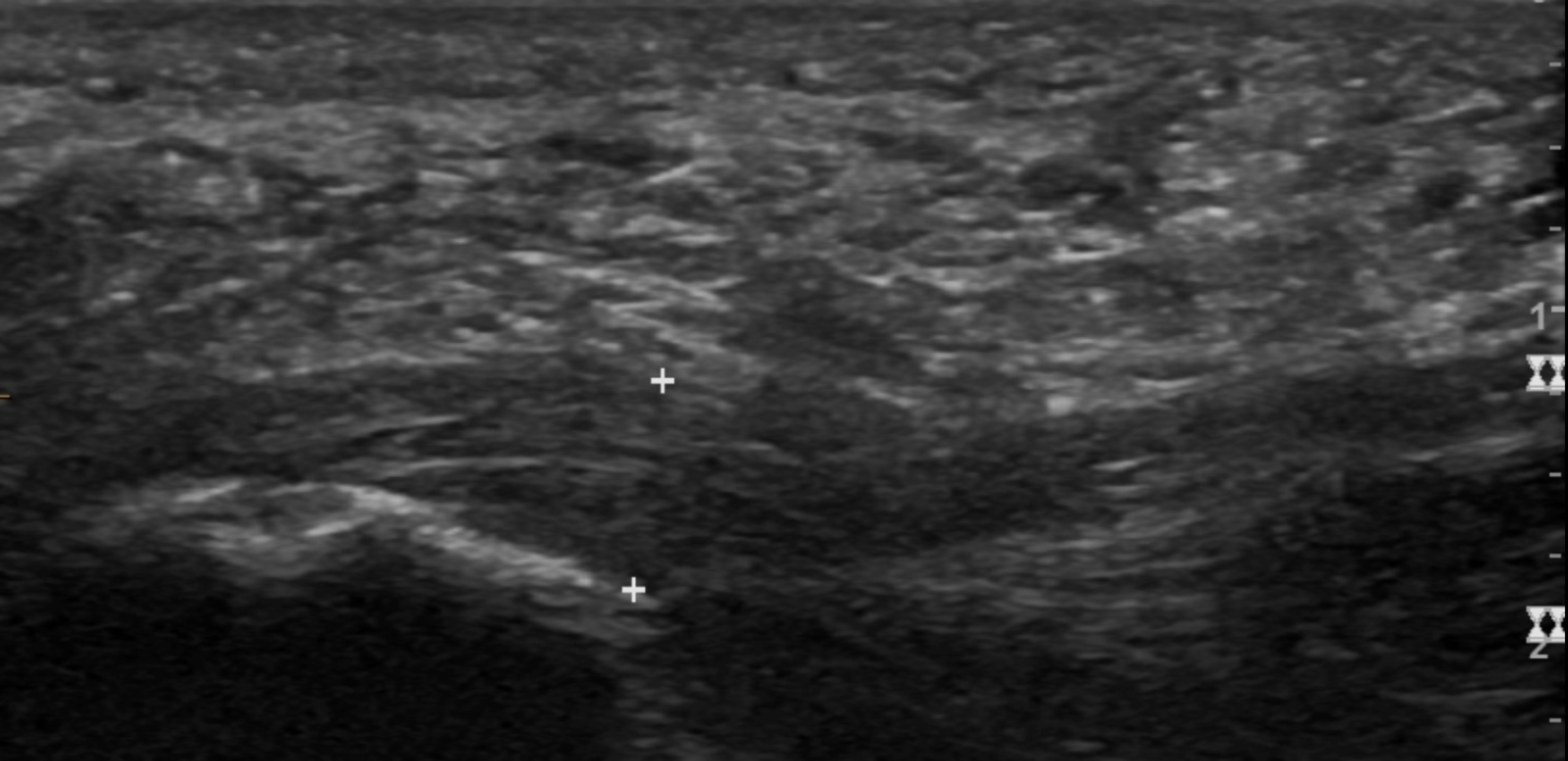 Thickened plantar fascia