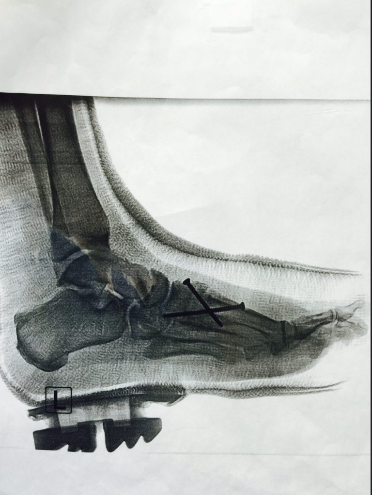 heel pain treatment xray