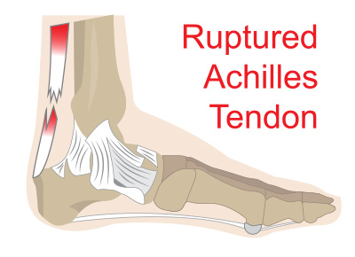 achilles tendon rupture diagram