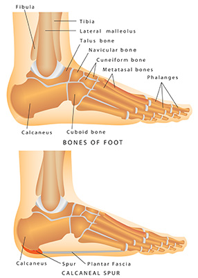 heel spur diagram