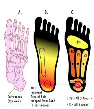 Shockwave Therapy Better Than Ultrasound For Heel Pain