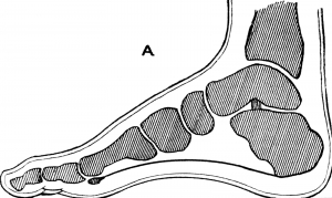 Heel Bursitis