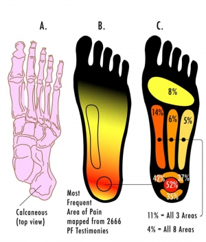 Plantar Fasciitis And Bone Spurs